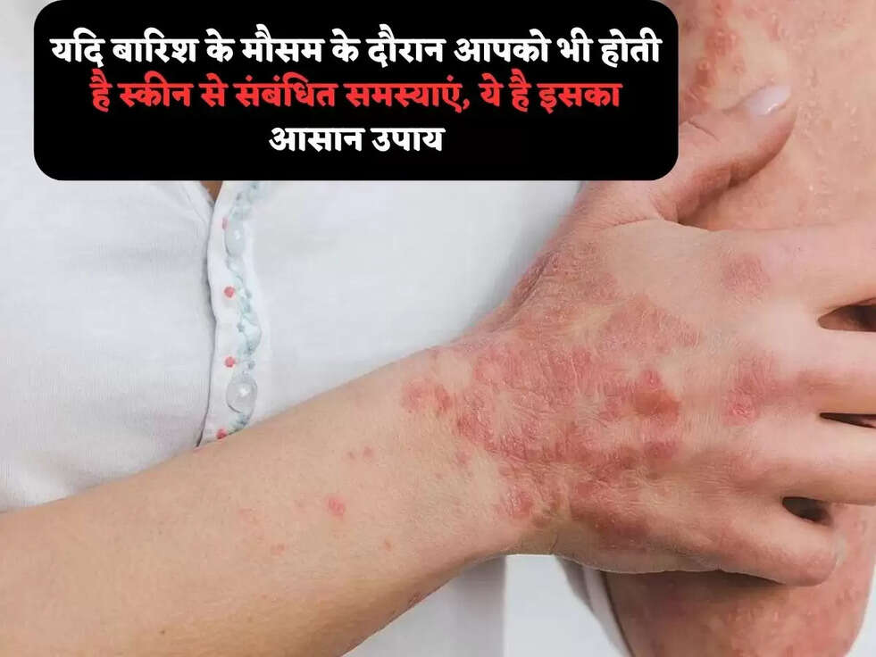 यदि बारिश के मौसम के दौरान आपको भी होती है स्कीन से संबंधित समस्याएं, ये है इसका आसान उपाय
