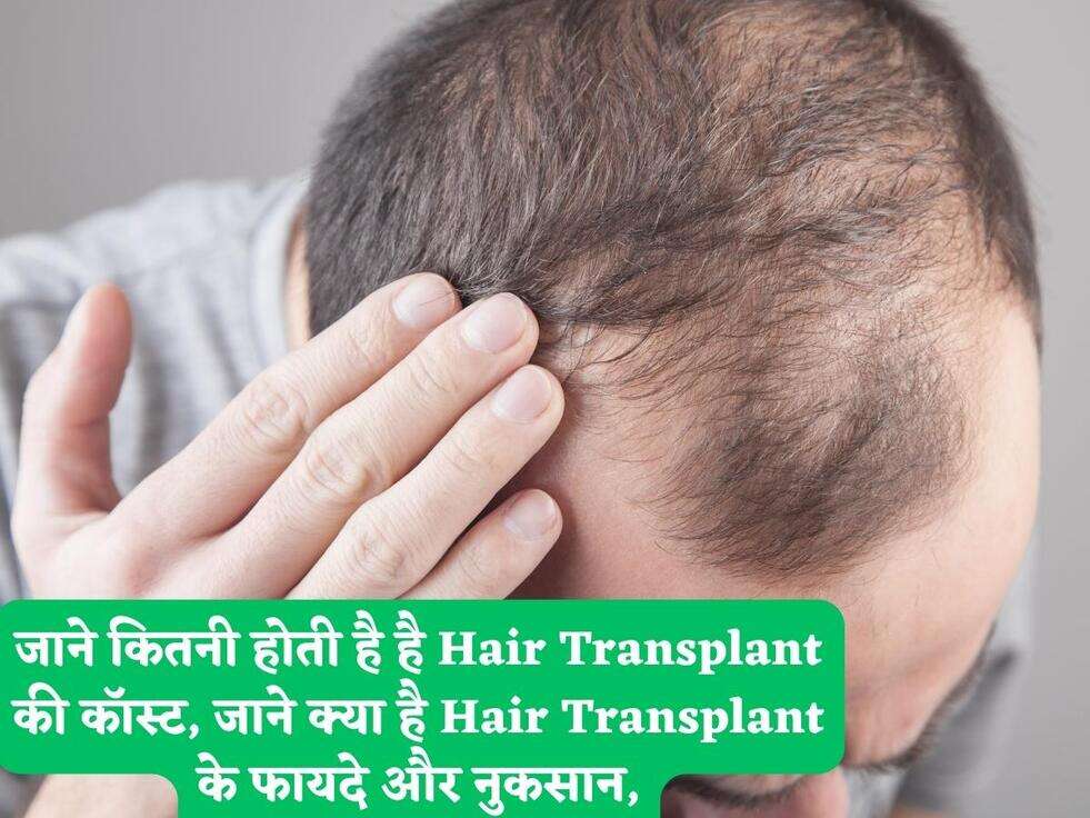 जाने कितनी होती है है Hair Transplant की कॉस्ट, जाने क्या है Hair Transplant के फायदे और नुकसान,