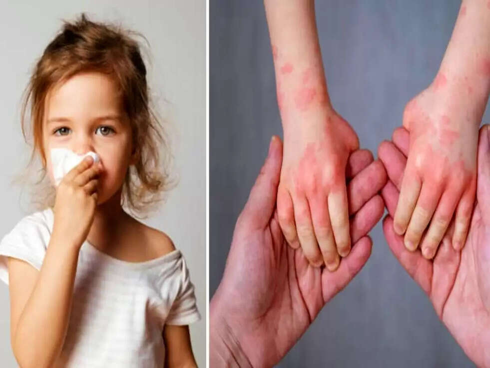 Tomato Flu: तेजी से फैल रहा  हैं Tomato Flu बच्चों को  हो सकता है खतरा