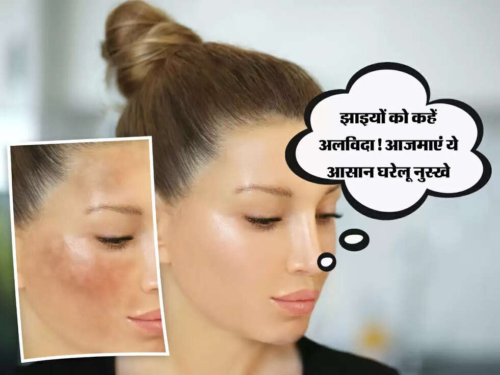 Goodbye Freckles:&nbsp;झाइयों को कहें अलविदा! आजमाएं ये आसान घरेलू नुस्खे
